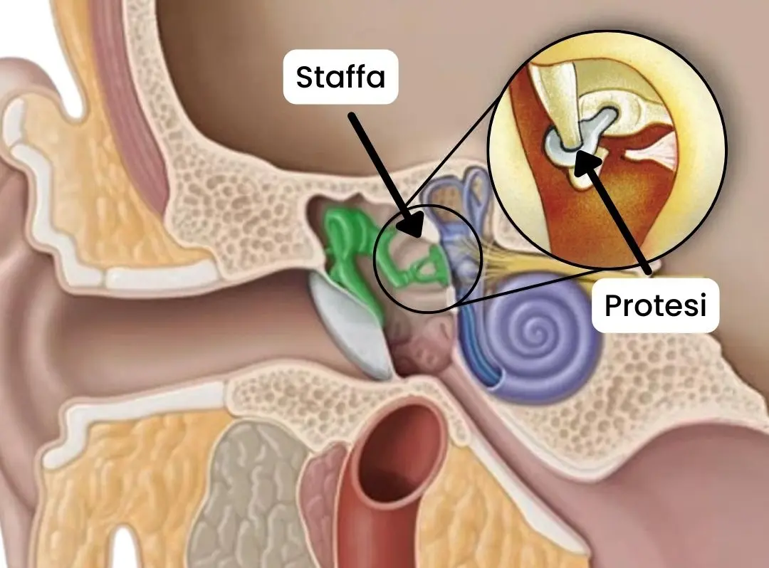 protesi per otosclerosi